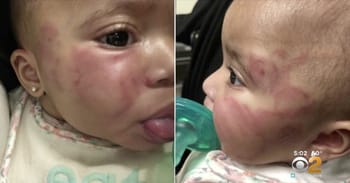 New Jersey Daycare Shuts Down After Baby Comes Homes Covered With Bite Marks And Bruises On Her Stomach And Face