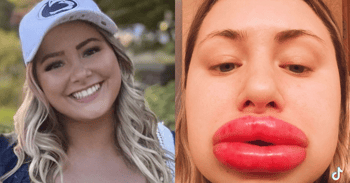 A Woman's Lips Swell To Eight Times The Normal Size After An Allergic Reaction To Fillers