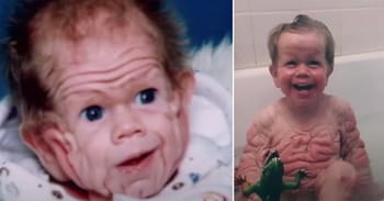 Tomm Tennent: Unique Baby Born With Enough Skin To Cover The Body Of A Five-Year-Old Child