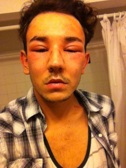 16 Images Of People Having Extreme Allergic Reactions ThatViralFeed