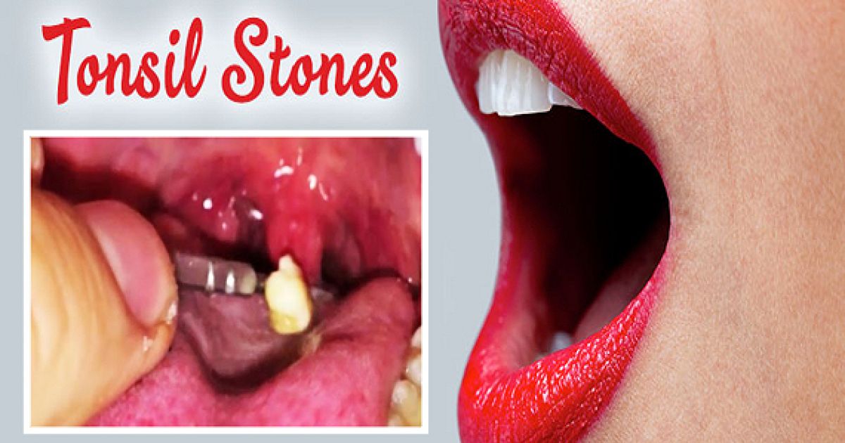 If You Have Bad Breath You May Have Tonsil Stones ThatViralFeed