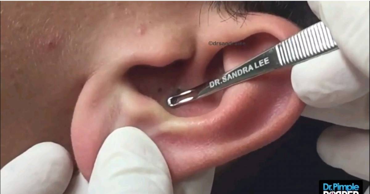 Sounds Gross Dr Pimple Popper Squeezes Blackheads In A Mans Ear Thatviralfeed