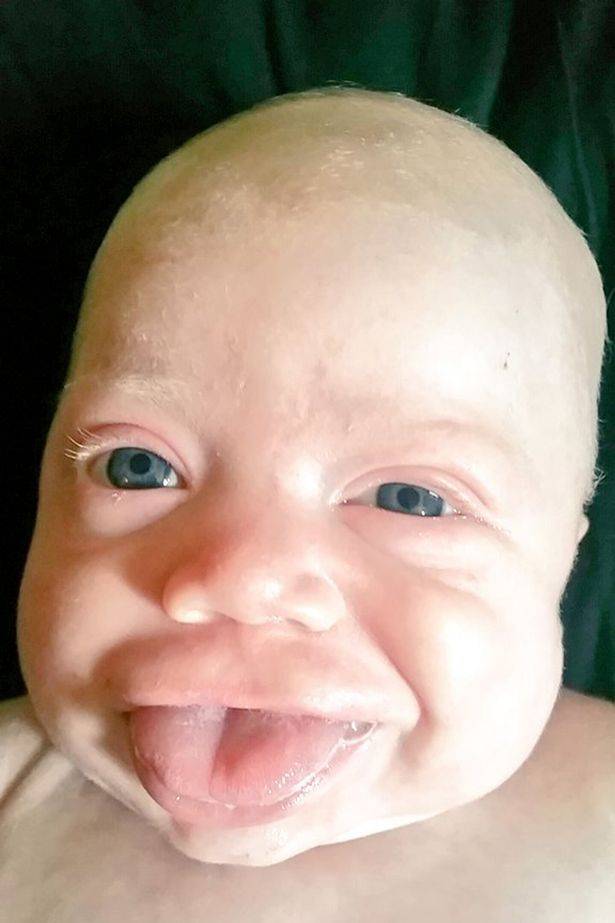 Baby Smiles For First Time After Lifechanging Operations To Fix Huge