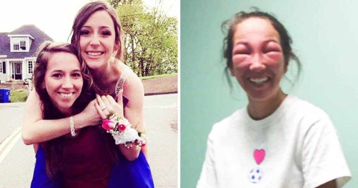 Girl’s Face Swells After Getting Poison Ivy in Her Eyes ThatViralFeed