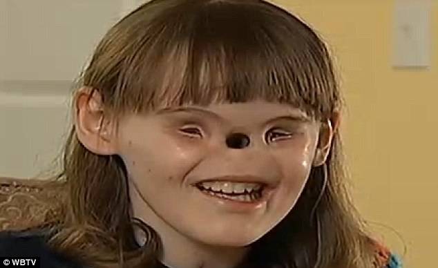 These 3 Kids Who Were Born Without Noses Defied The Odds And Inspired