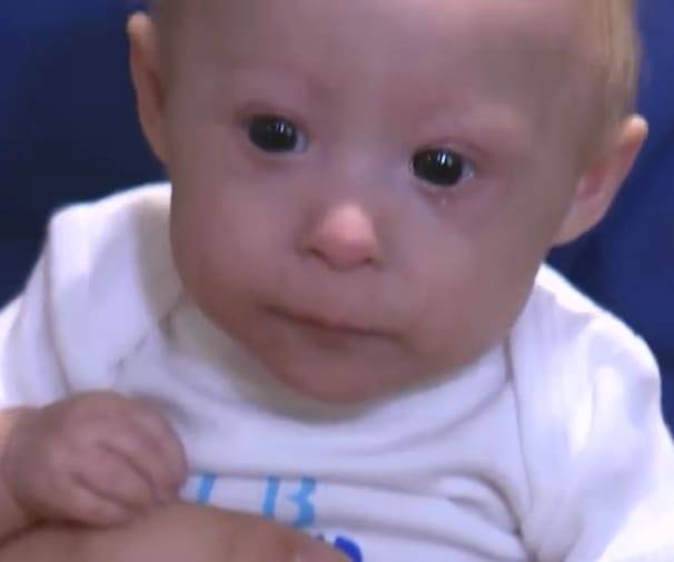This 3Pound Baby Was Born With A Rare Growth Disorder That Makes Him