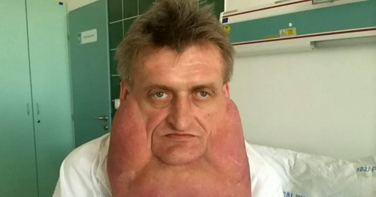 This Man’s Chin Suddenly Grew To Weigh 15 Pounds And Now Look At Him ...