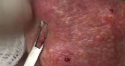 When All His Blackheads Were Popped Open, This Is What Happened