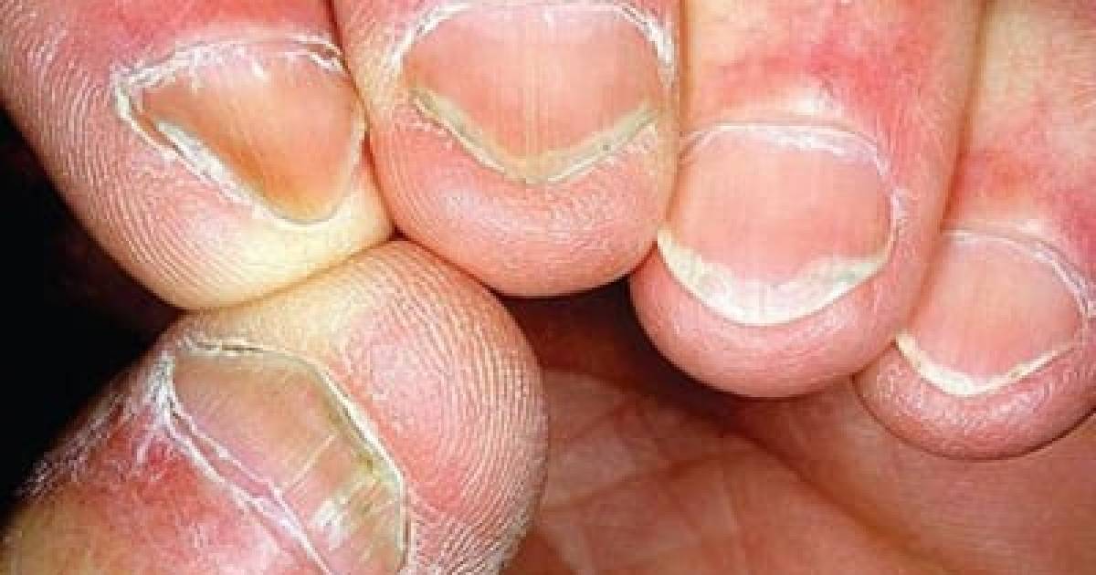 8 Simple Tricks To Soothe And Heal Dry, Cracked Fingertips This Winter