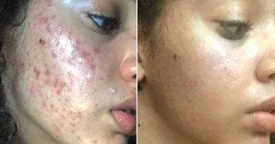 Everyday Household Products That Cured This Woman's Acne
