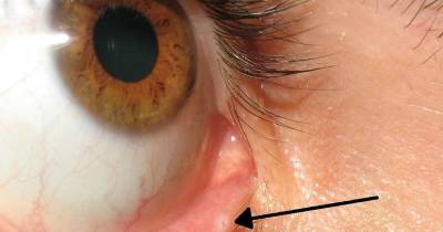 You Probably Never Noticed Tiny Hole On Your Eyelid And Here’s What It’s For