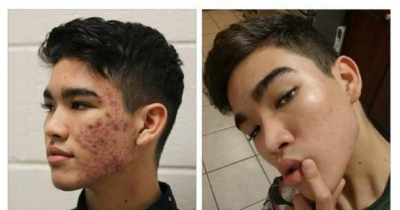 Teen Shares DIY Budget Skincare Routine That Successfully Cleared His Severe Acne