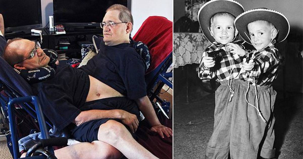 World's Longest Living Conjoined Twins Have Died Aged 68 | ThatViralFeed