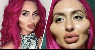 Woman Says She Is Getting More Attractive Attention From Men Ever Since Injecting Cheek Fillers