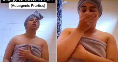 Woman Allergic To Water Shares How She Washes Herself