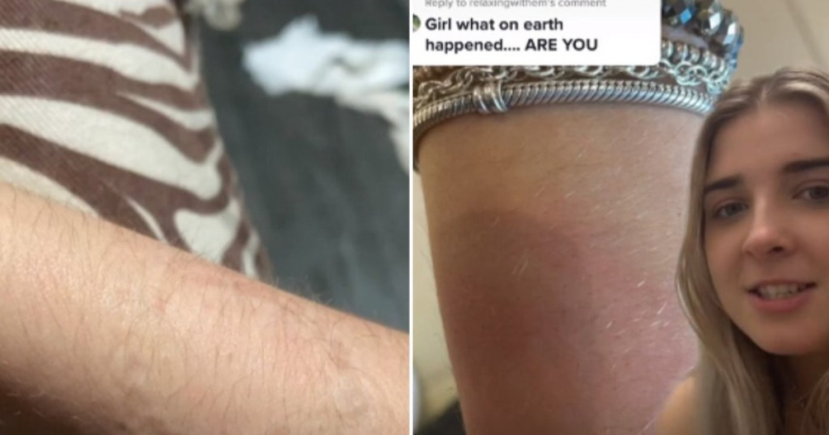 Woman Finds Bitemarks A Day After She Passed Out At A Nightclub