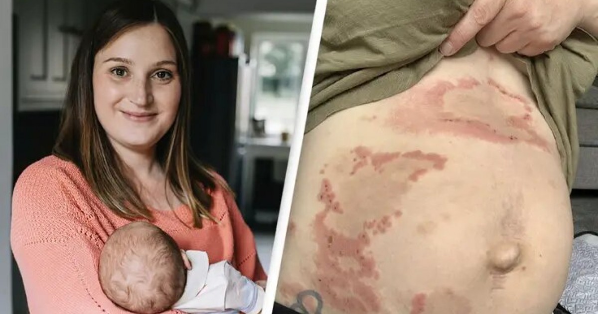 Woman Finds Out She Is Allergic To Her Own Baby, Rare Condition Affects One In 50,000