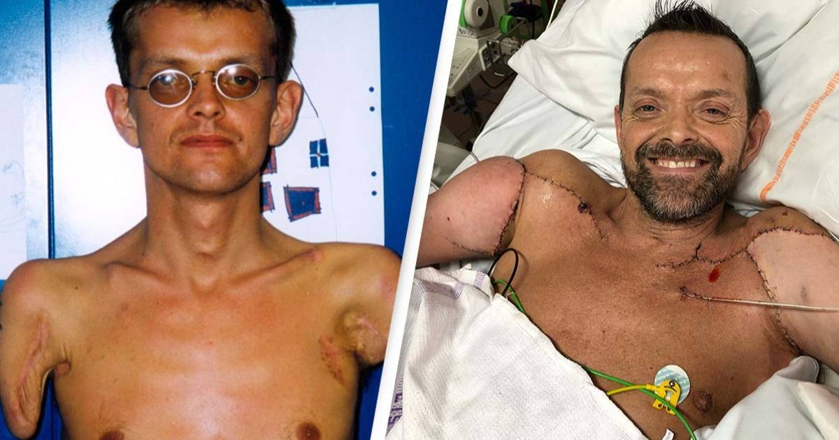 Man Who Underwent World’s First-Ever Double Arm And Shoulder Transplant Recipient Makes Remarkable Recovery