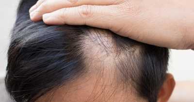 Alopecia: FDA Approves Game-Changing Medicine For Hair Loss Treatment