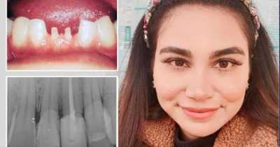 Mom's Teeth Left As Tiny Stumps After 'Devastating' Dental Treatment In Turkey