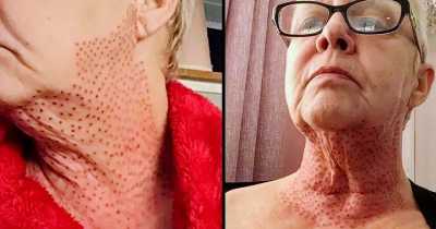 Horrified Woman Left ‘Looking Like A Lizard’ After A Botched Skin Tightening Procedure