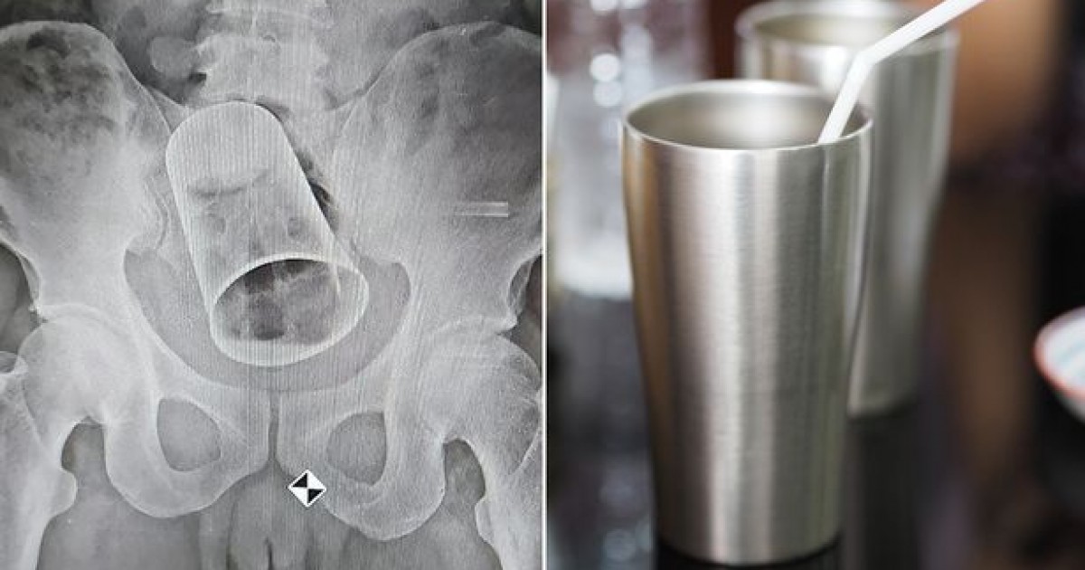 Doctors Remove A Steel Cup From A Man’s Rectum In India