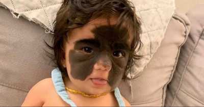 Two-Year-Old Girl Has ‘Batman’ Birthmark Removed In Pioneering Surgery