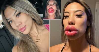 Woman's Lips Ballooned To Triple Their Size After Allergic Reaction To Cheap Fillers