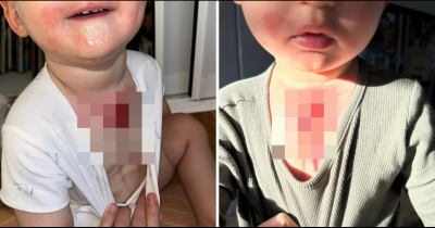 Mom Issues Warning To Parents After Son Suffers Serious Burn From Fruit