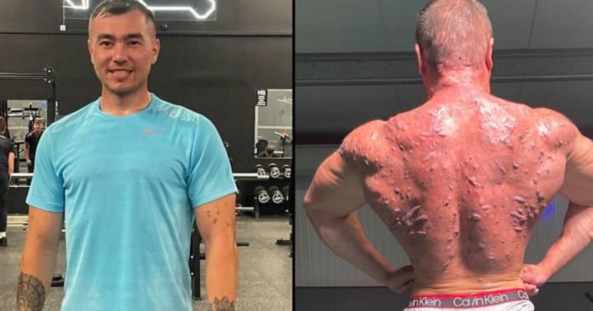 Bodybuilder Shows Off Serious Damage Steroids Have Done To His Body In A Bid To Warn Others