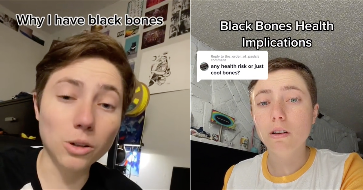 TikTok User Left Shocked To Learn The Bones In His Body Have Turned 'Black' Due To Rare Disease