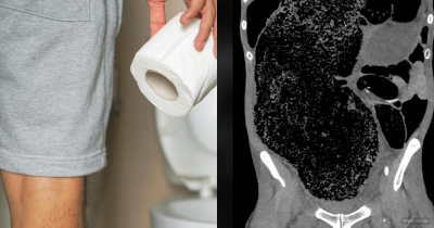 Man Loses Feeling In His Legs And Nearly Dies Due To Colossal Poop