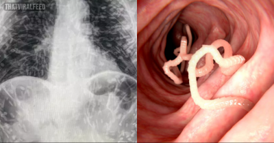 Man Who Went To Hospital With Cough Shocked To Discover He’s Swarming With Tapeworms