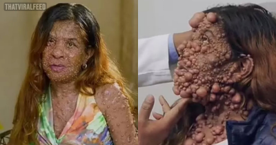 Mom With 'One-of-a-Kind' Condition Can Finally See Her Own Face Again After More Than 60 Hours Of Surgery