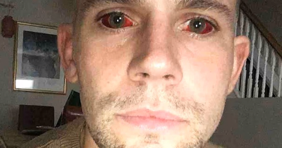 Man Warns Others After Five-Day Cocaine Binge Left Him With 'Devil Eyes' And Nearly Cost Him His Life