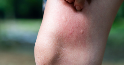 Mom, 33, Issues Warning After Thinking She Had A 'Mosquito Bite' That Turned Out To Be Something Serious