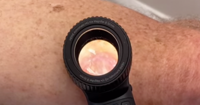Australian Doctor Shows 'Worst' Skin Cancer He's Ever Seen In Alarming TikTok Clip