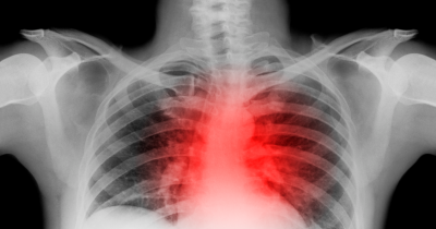 Cardiologist Who Survived Heart Attack Shares Warning About Overlooked Symptom: 'Don't Make My Mistake'