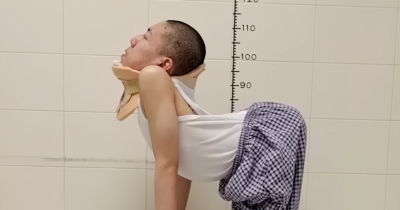 'Folded Boy' Finally Stands Tall After Living Most Of His Life With A Spine Bent At A 180-Degree Angle