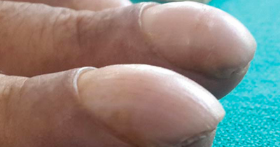 'Clubbing' Explained — Why A Sudden Change In Your Fingers Could Point To A Serious Disease