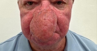 Man Unable To Kiss Wife After One Of The 'Worst Cases' Of Nose Growth Doctors Had Ever Seen